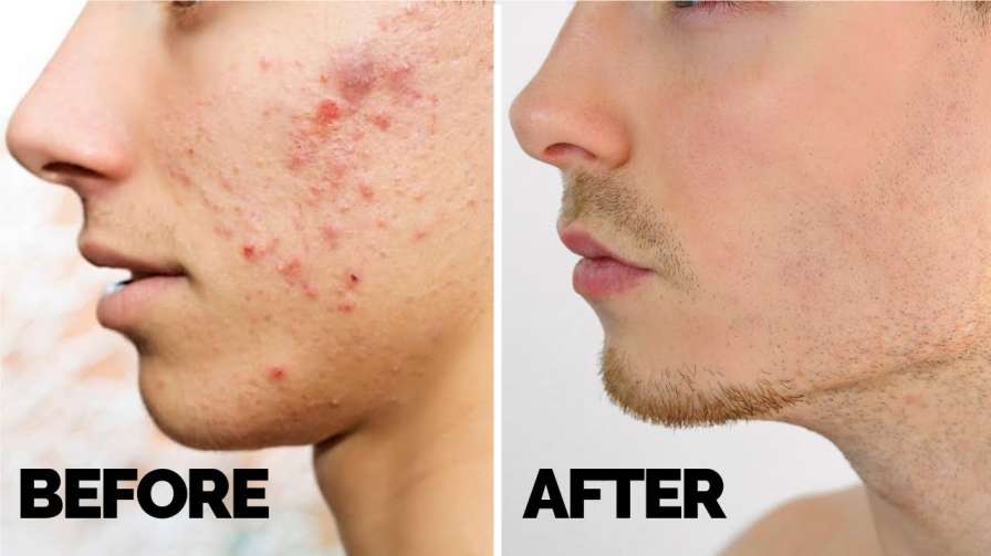 Get rid of acne and pimples